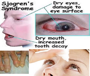 Dry Mouth Sjogren S Treatment Natural Dry Mouth Sjogren S Treatment Natural