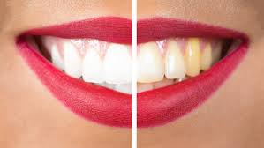A Dentist Friend Told Me How Whiten Your Yellow Teeth in less than 2 Minutes