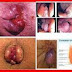 OBAT BAB BERDARAH HERBAL thumbnail