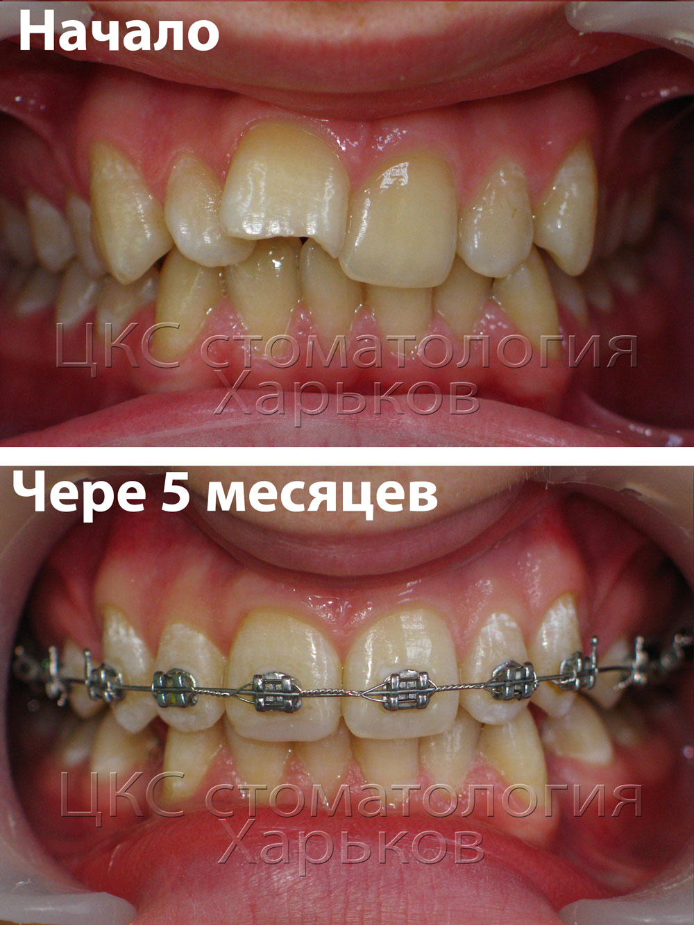 Брекеты и брекет системы Брекеты и брекет системы