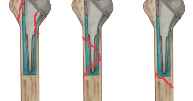 Shoulder Arthritis / Rotator Cuff Tears: causes of Shoulder Arthritis / Rotator Cuff Tears: causes of
