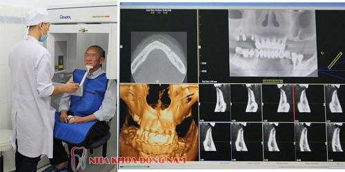ĐÁNH GIÁ TIÊU CHUẨN CHẤT LƯỢNG XƯƠNG HÀM TRONG CẤY GHÉP IMPLANT -2