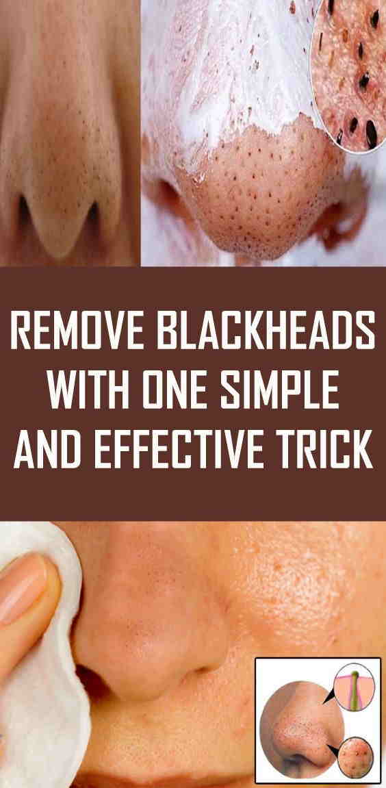 Remove Blackheads With One Simple And Effective Trick Fitness And Health Tips