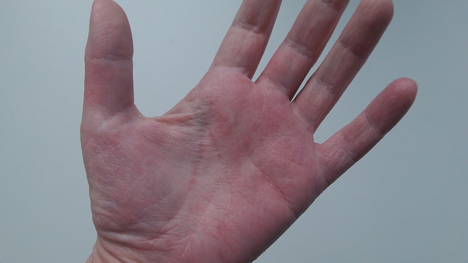 itchy rash on palms of hands