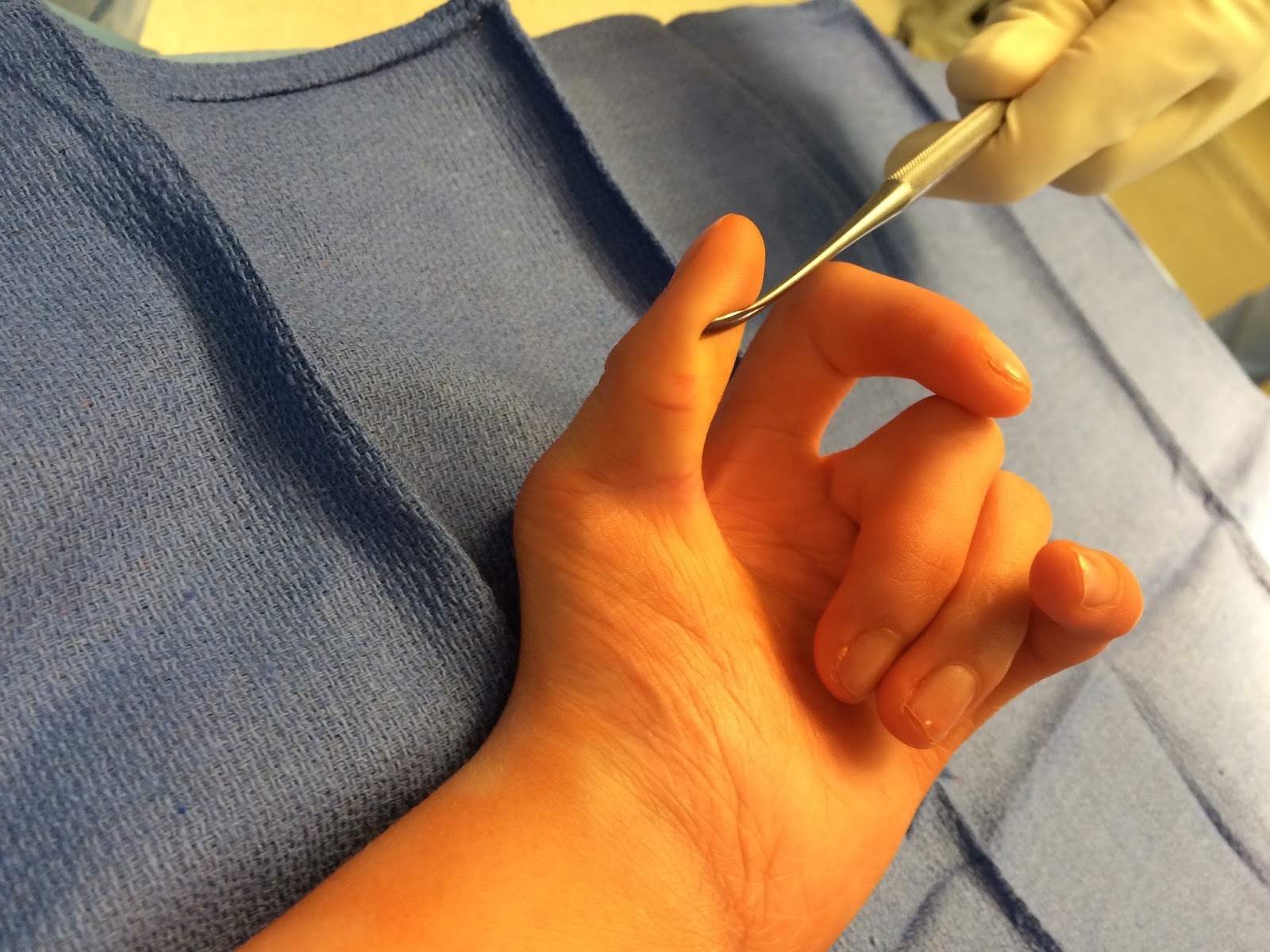 The Arthrogryposis Thumb Congenital Hand and Arm Differences