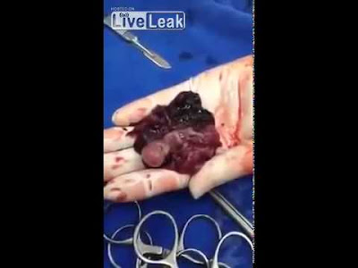 جنين عمره 14 أسبوعا يخرج من رحم أمه حيًا