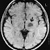 Taux de survie au cancer du cerveau - oser comprendre la chance