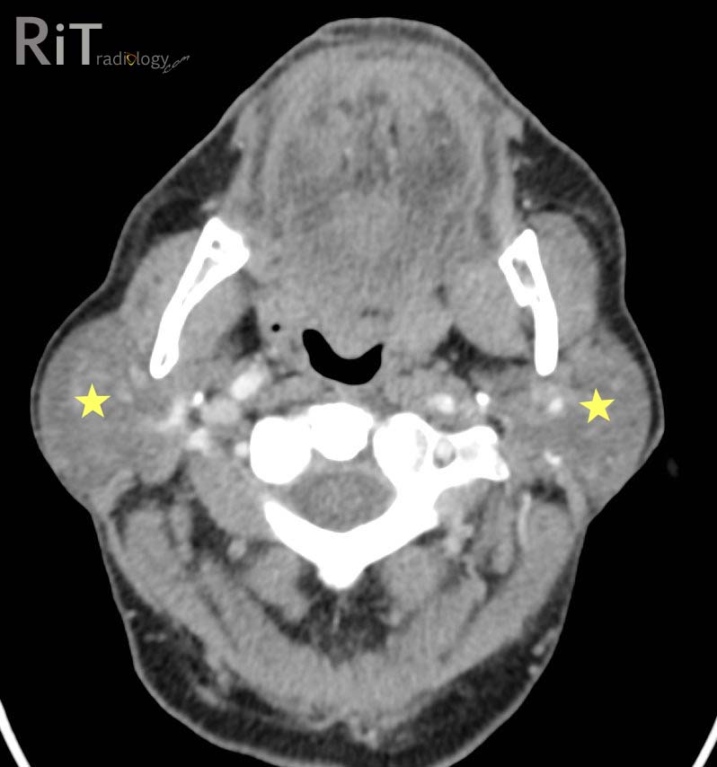 RiT radiology: Lymphoepithelial Cysts in HIV