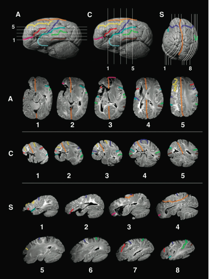 Spagnoli CogBlog 432H CogBlog 2 Brain Injury Case Study