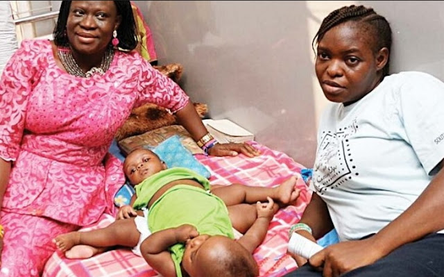Photos: Nigerian Conjoined Twins Miracle & Testimony Ayeni’s Surgery Sponsored By Arik Air