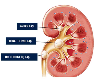 Genişletilmiş renal pelvis: nedenleri, tanı ve tedavi Genişletilmiş renal pelvis: nedenleri, tanı ve tedavi