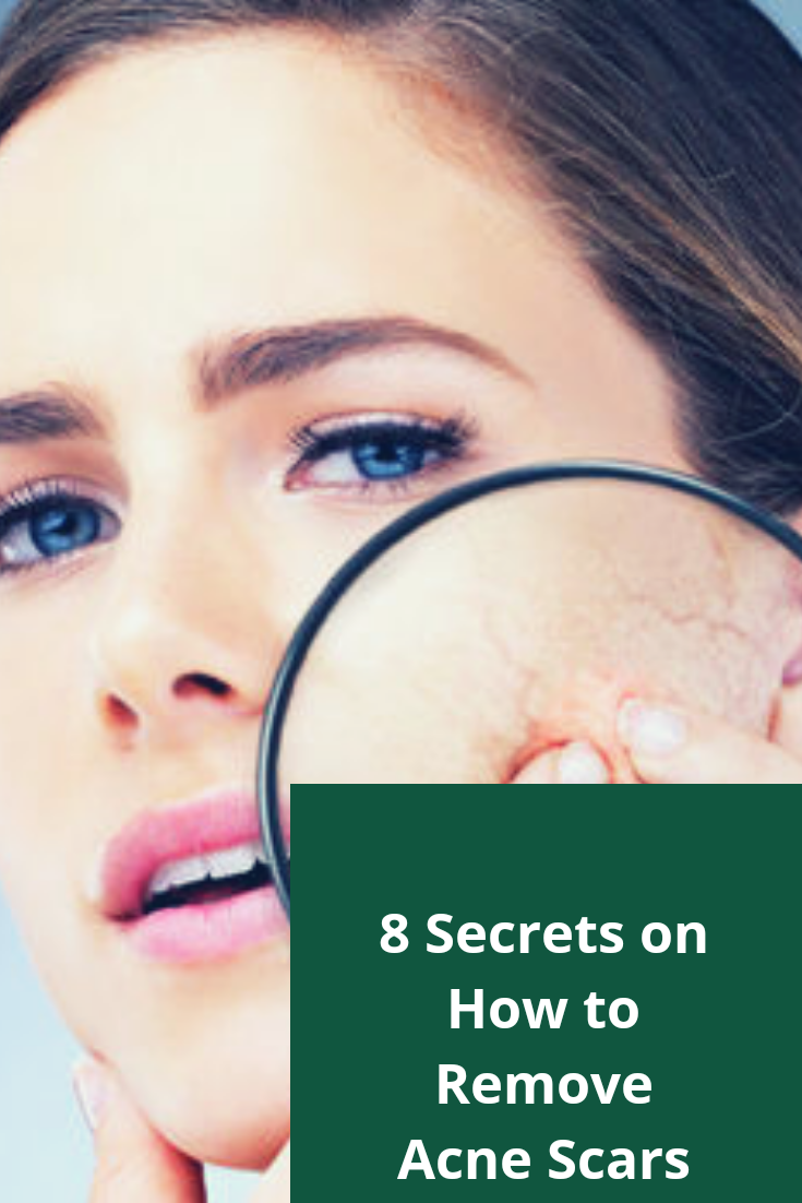 8 Secrets on How to Remove Acne Scars