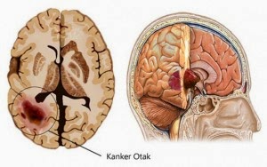 Cara Mengatasi Berbagai Macam Penyakit Cara Alami Mengobati Kanker Otak
