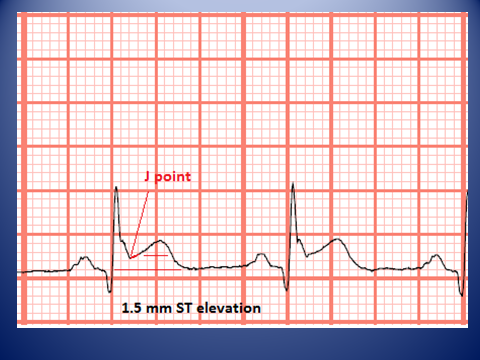 telemetry technician course measuring st elevation and ekg graph paper