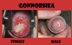 Apa Obat Untuk Kencing Nanah Apa Obat Untuk Kencing Nanah