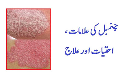 skin psoriasis meaning in urdu