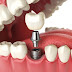 Những trường hợp không nên trồng răng implant