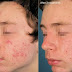 Information About Causes Of Acne Conglobata Treatment And Management
