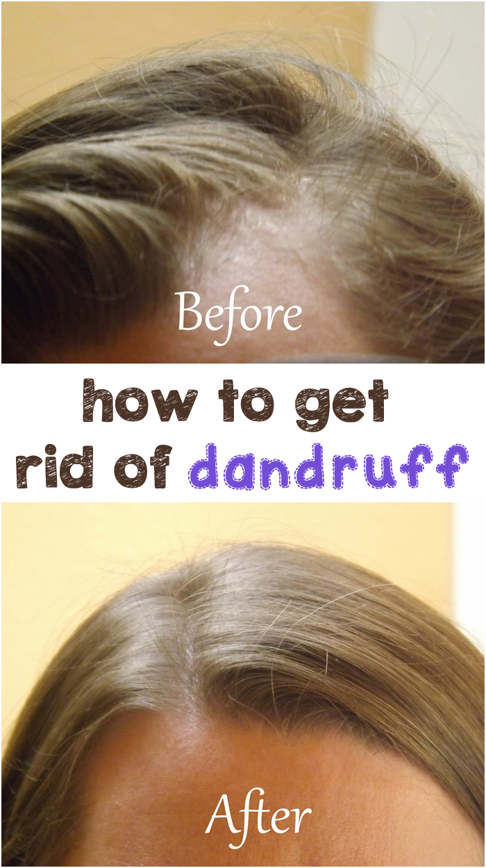 How to Get Rid of Dandruff FITNESS SHORTCUT