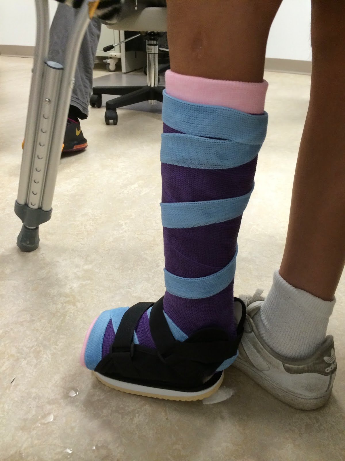 fibular hemimelia leg lengthening Pin Removal and Walking Cast