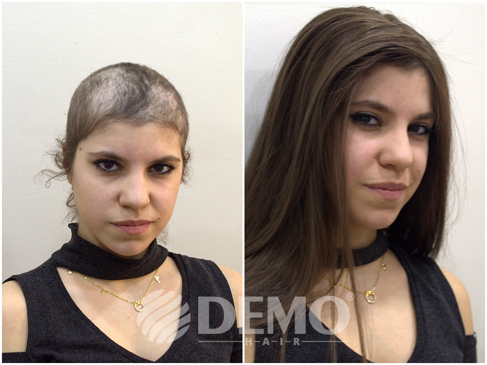 Protez Saç Kullanan Ünlüler