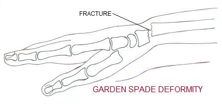 Smith S Fracture
