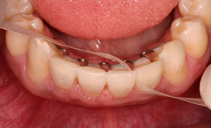 WEBINAR: Interrelação Ortodontia-Dentística - Prof. Rafael Bicalho