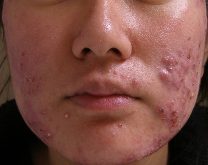 Health Secrets: Tretinoin cream best acne cream for acne plague