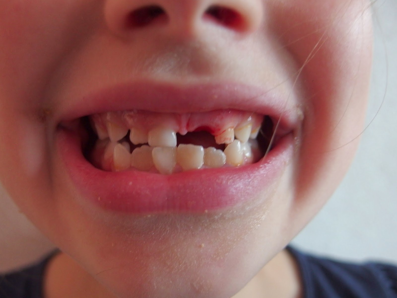 Hanne van Essen tand eruit