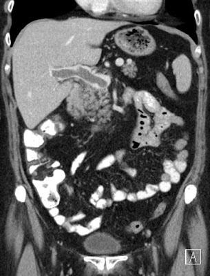 Portal vein thrombosis – Thrombosis venae portae