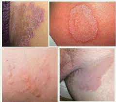 CARA MENGOBATAI GATAL DI SELANGKANGAN SEPERTI PULAU CARA MENGOBATAI GATAL DI SELANGKANGAN SEPERTI PULAU