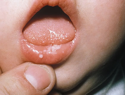 mouth yeast infection #9