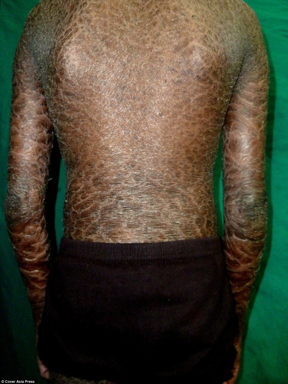 Effiong Eton Rare Skin Disease Leaves Brother And Sister With Scales All Over Their Bodies