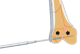 Lag screw used to repair bone fracture