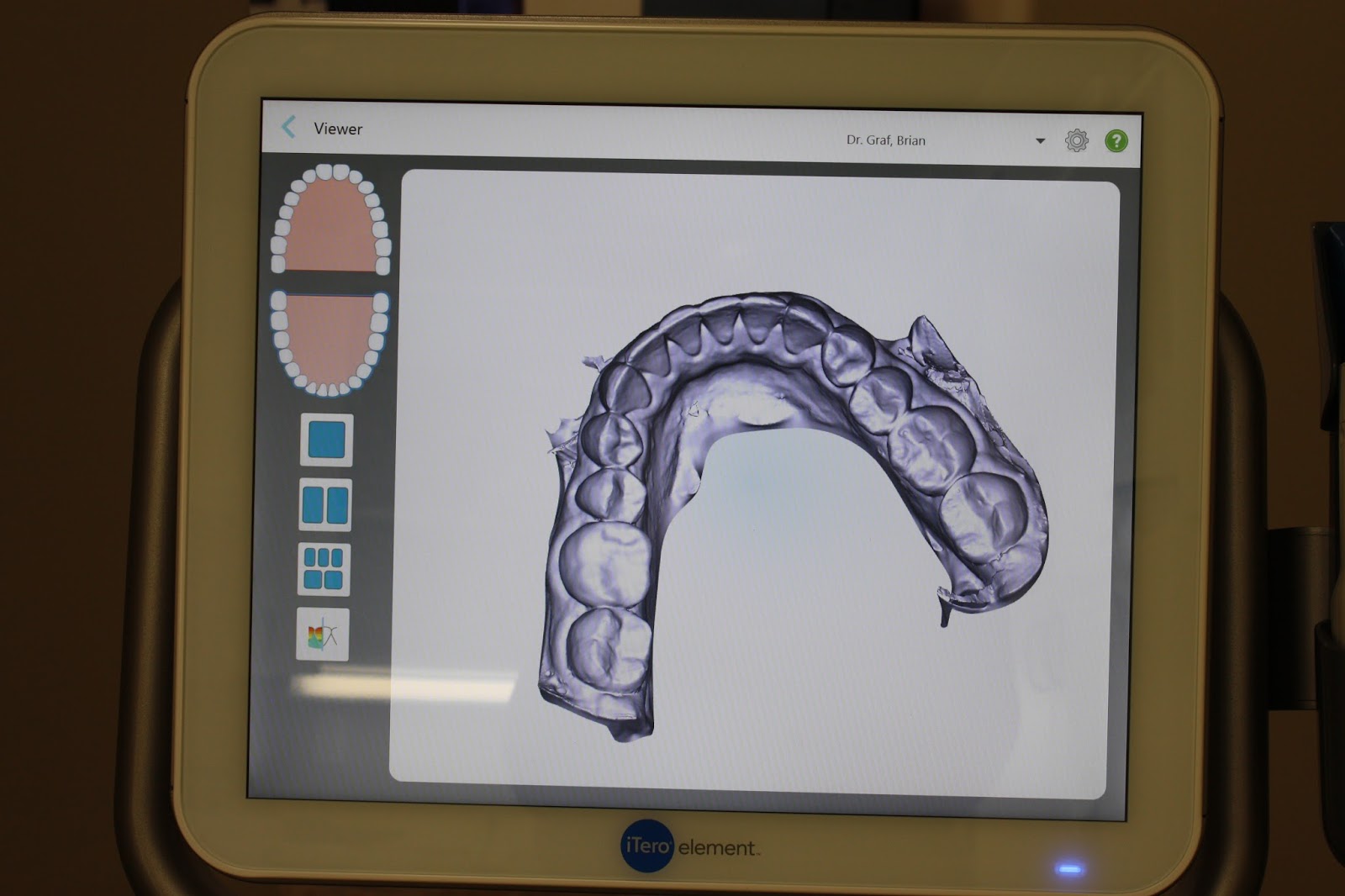 Graf Orthodontics No more gagging, messy impressions!