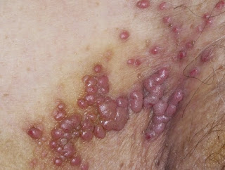 Que Es Bueno Para El Herpes Que Es Bueno Para El Herpes