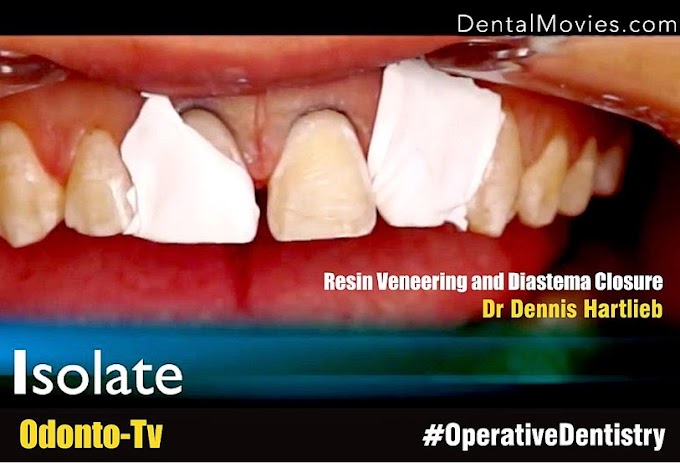 DIASTEMA CLOSURE: Resin Veneering - Dr Dennis Hartlieb