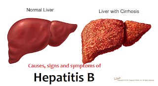हेपेटाइटिस, हेपेटाइटिस क्या है, हेपेटाइटिस b, हेपेटाइटिस ई, हेपेटाइटिस c, हेपेटाइटिस सी, हेपेटाइटिस सी के लक्षण, अल्कोहलिक हेपेटाइटिस, हेपेटाइटिस सी का आयुर्वेदिक उपचार
