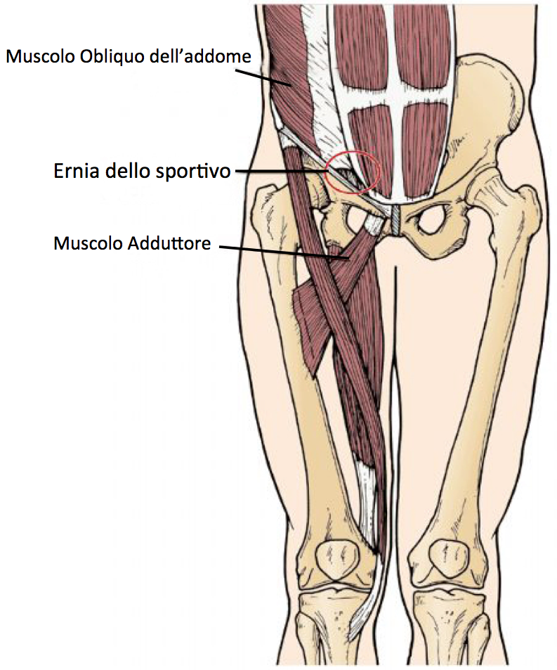 dolore allinguine dopo la riparazione dellernia dolore allinguine dopo la riparazione dellernia