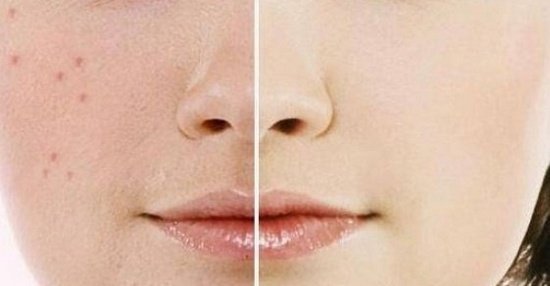 35 Cara Menghilangkan Flek Hitam di Wajah yang Membandel (Alami & Modern) 35 Cara Menghilangkan Flek Hitam di Wajah yang Membandel (Alami & Modern)