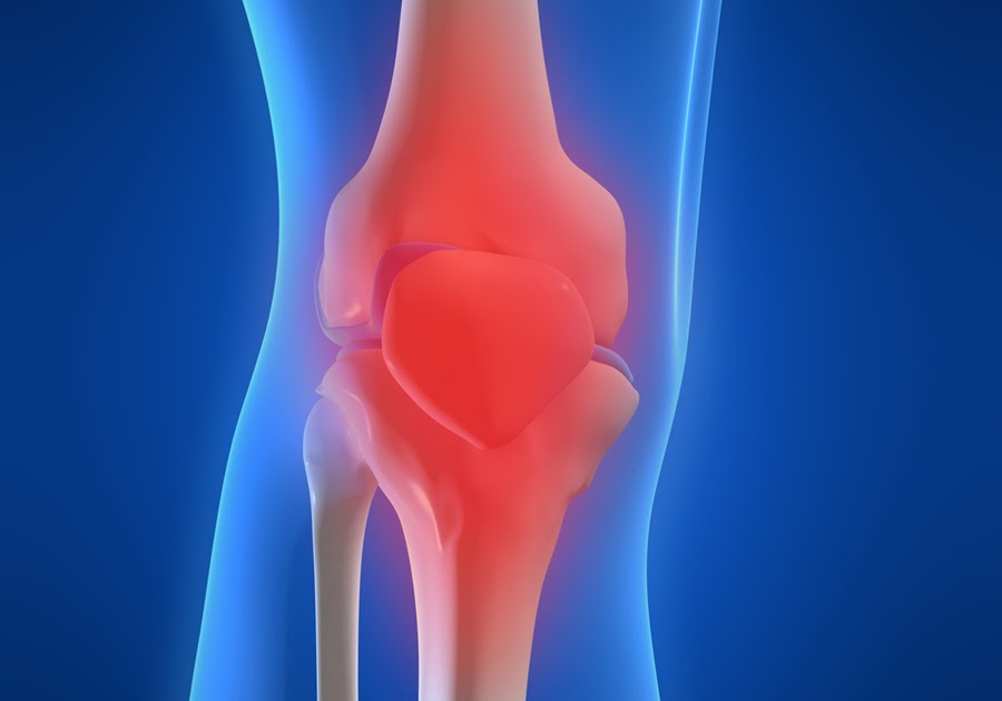 Лечение артрита суставов в домашних условиях. Синовит артроз коленного сустава. Реактивный артрит коленного сустава. Остеоартрит (артроз, дегенеративные заболевания суставов).