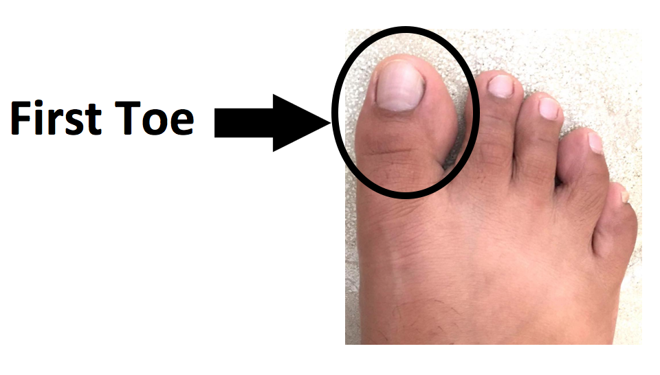 Sanhi Ng Gout Sa Paa paa mesa