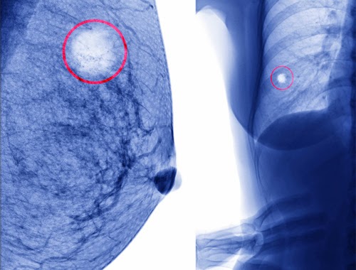 como quitar un tumor de seno