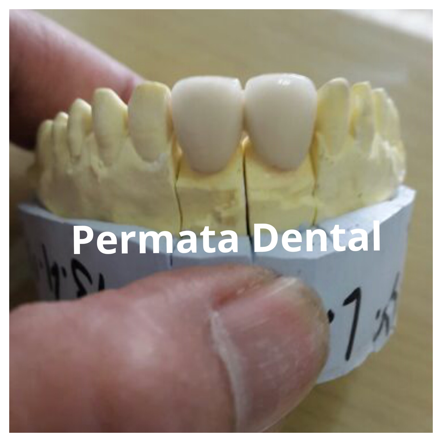 Gambar Crown Bridges Gigi Sehat Mahkota Porselen Geraham Bridge