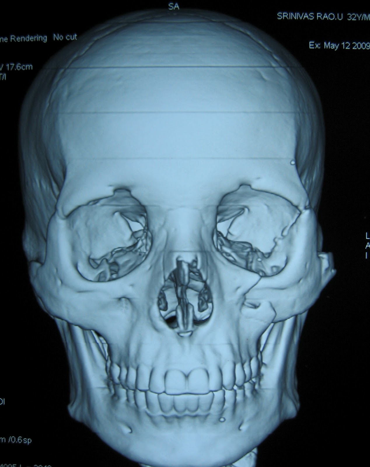 Zygomatic Fracture Fracture Treatment