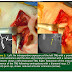 Management of Recurrent Dislocation of the Temporomandibular Joint
(TMJ)