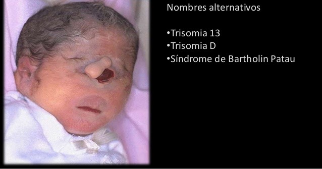 S ndrome de Patau