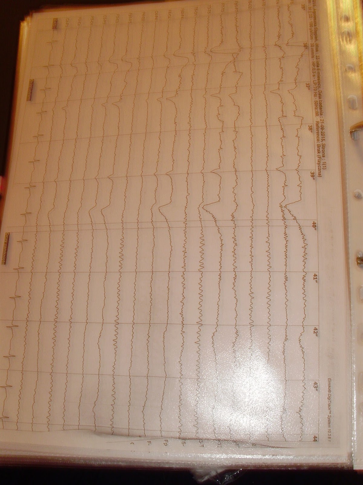 EDS ( Zespół Ehlersa - Danlosa) Choroby rzadkie, genetyczne