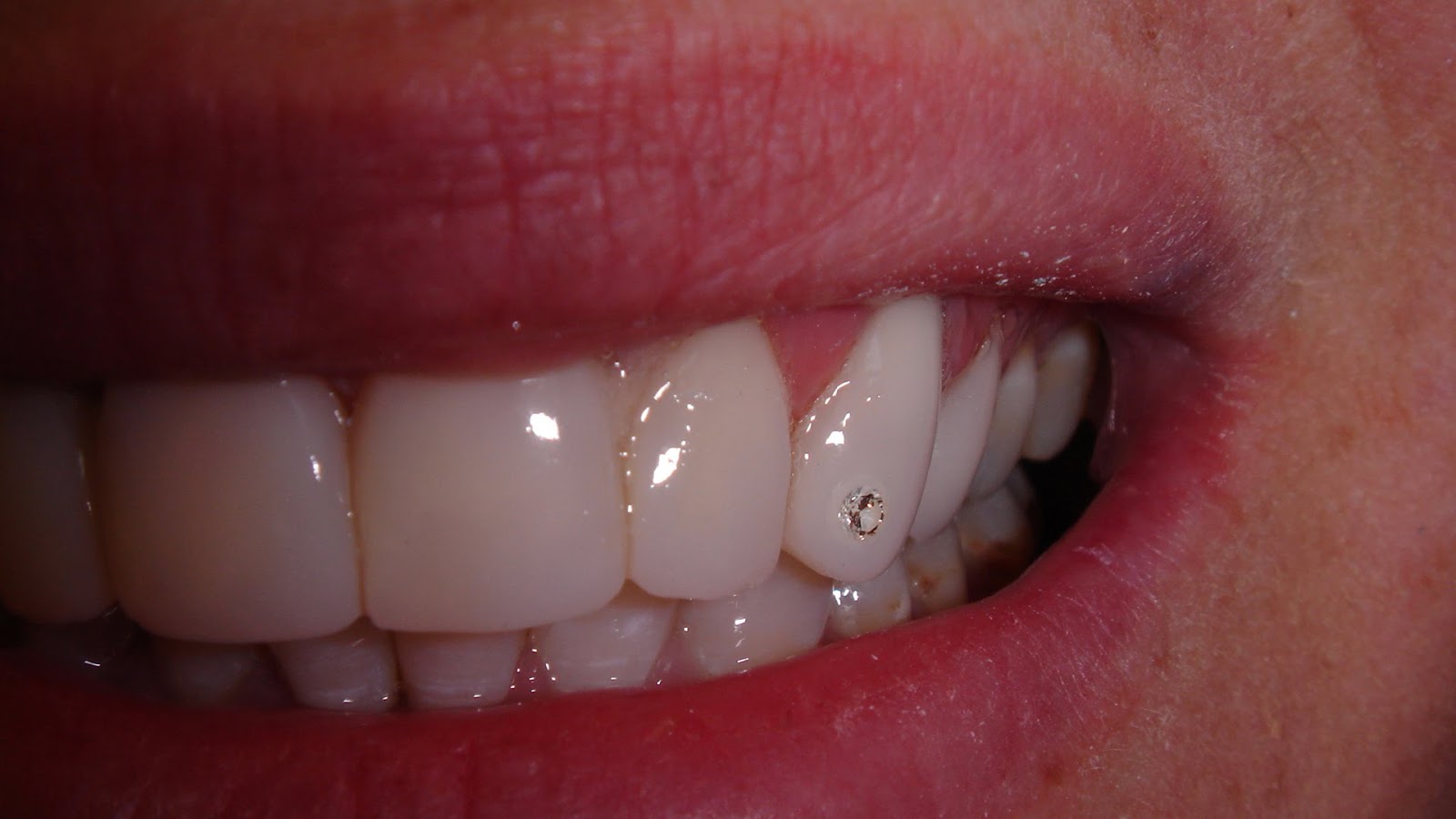 Tooth Jewellery By All Smiles Dental Spa Dubai Cosmetic Dentistry