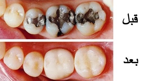 أسباب تسوس الأسنان و كيفية علاج تسوس الأسنان و الوقاية منه ريتاج